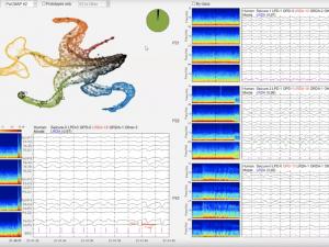 example of EEG graphs from researchers' AI tool